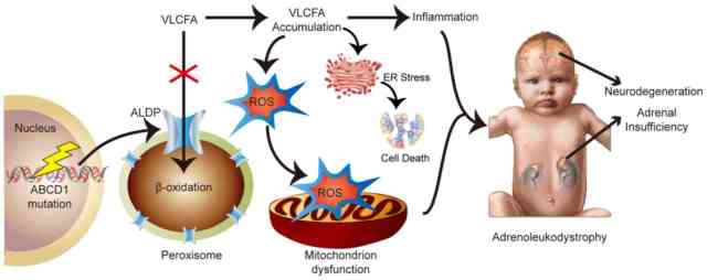 amn adrenomyeloneuropathy glutathione Adrenoleukodystrophy Proposed model for X-ALD disease